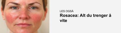 Banner med link til relatert innlegg med fakta om rosacea