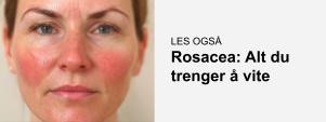 Lær mer om rosacea, triggere, årsak, behandling