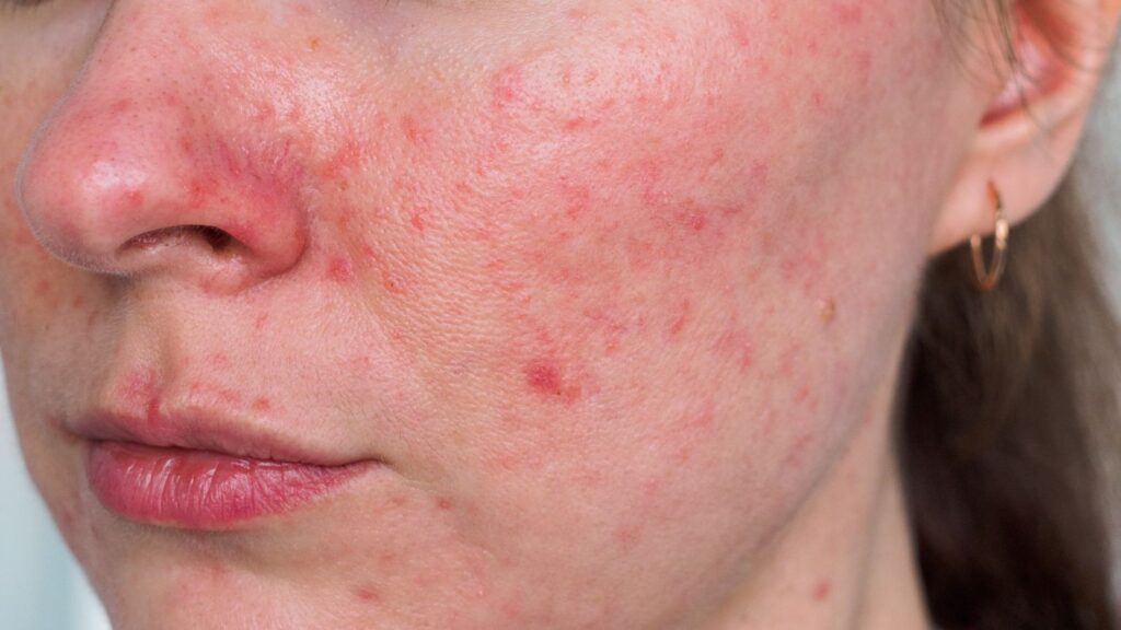 Rosacea nærbilde. Rødhet og sensitiv hud