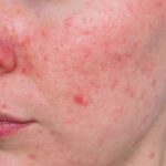 Rosacea nærbilde. Rødhet og sensitiv hud