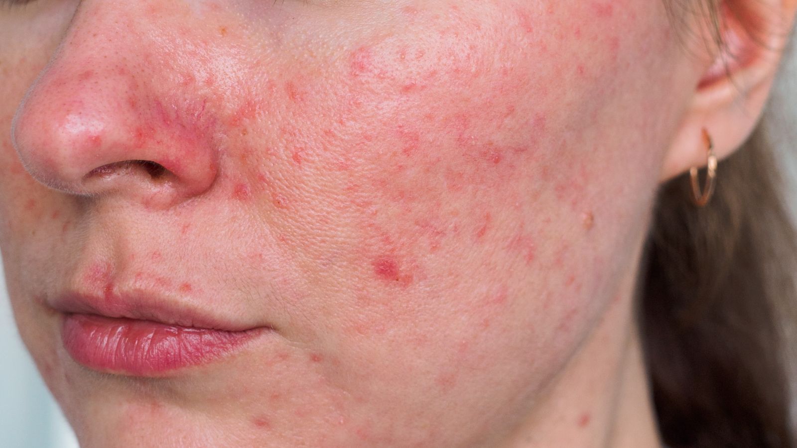 Rosacea: Symptomer, årsaker, triggere og behandling – komplett guide