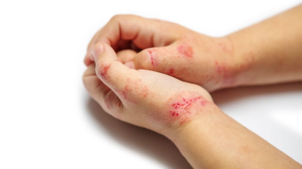 Hender med håndeksem på hvit bakgrunn