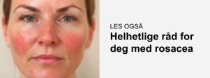 Bilde som linker til relatert artikkel om helhetlige råd for rosacea
