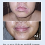 Jente med atopisk eksem før og etter 12 dager med rå skincare. Her ser du en stor forbedring på huden