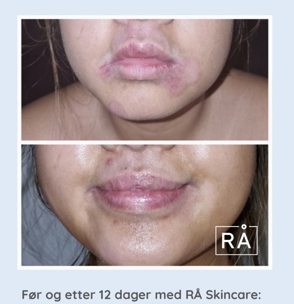 Jente med atopisk eksem før og etter 12 dager med rå skincare. Her ser du en stor forbedring på huden