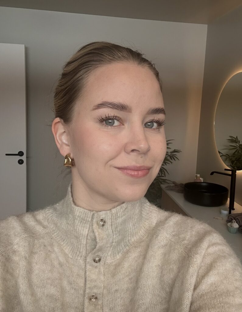 Potrettbilde av Laura som har perioral dermatitt.