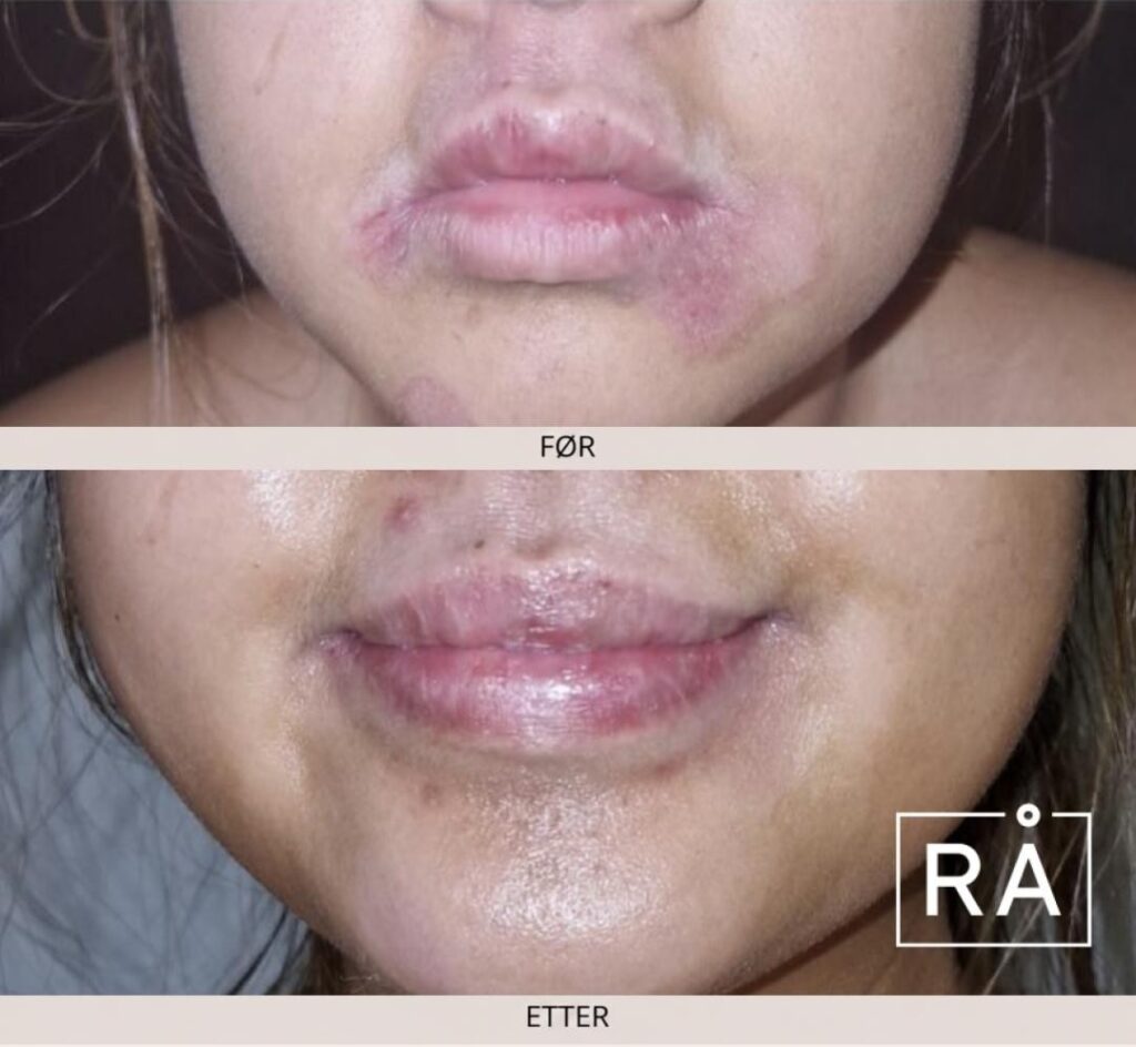 Before and after photo of a client with atopic eczema around the mouth